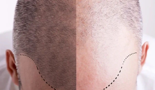 Hair Transplant Antalya